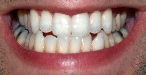0815 ctt teeth feature